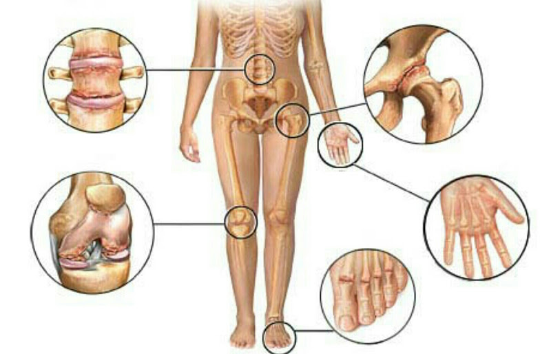 analize medicale pentru artroza